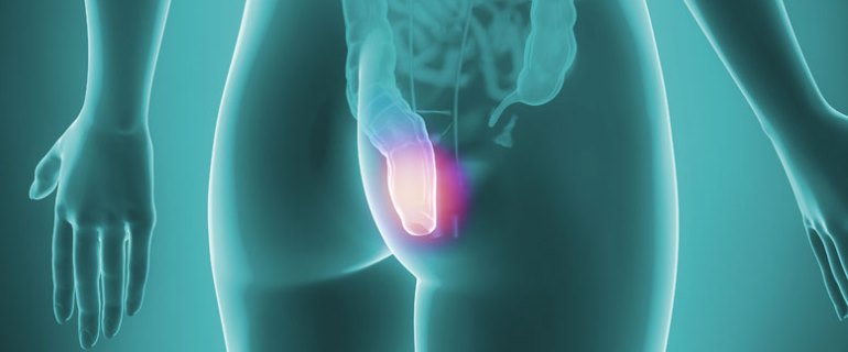 cirugia hemorroides cancun